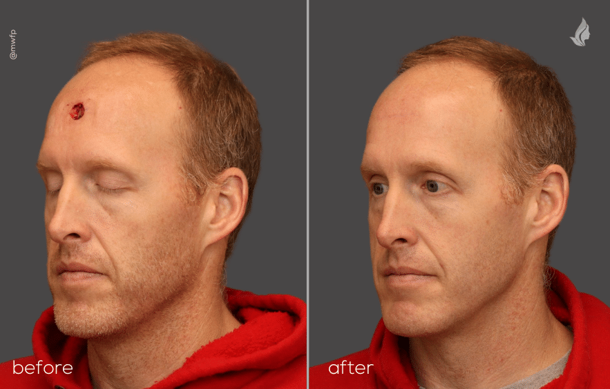 Mohs reconstruction patient care